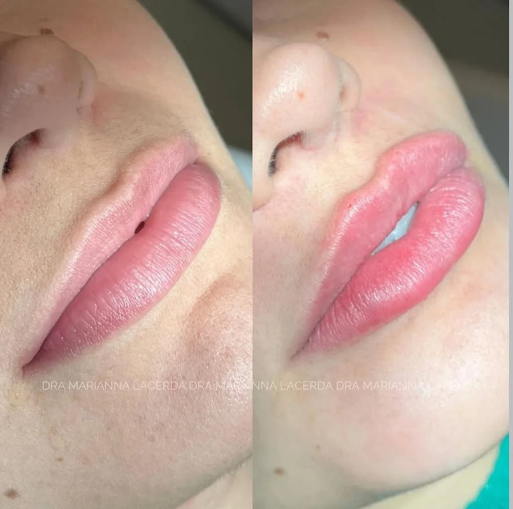 Dra. Marianna Lacerda l Harmonização Facial Goiânia – foto 3