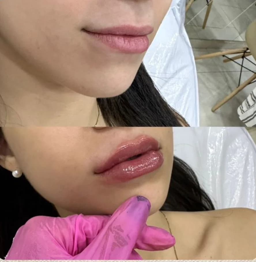 Be on TOX- Harmonização Facial, Botox, Preenchimento labial, Bioestimulador de colágeno, Sculptra - Araraquara
