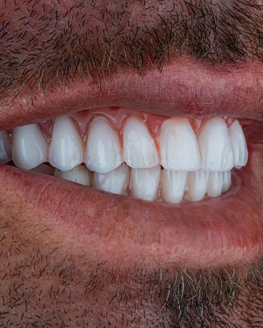 Implantes Dentários | Dentista | Clínica Coimbra Odontologia | Nova Iguaçu RJ – foto 3