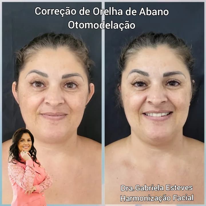 Dra. Gabriela Esteves - Otomodelação, botox , preenchimento , Harmonização Facial , Rinomodelação , lipo de papada – foto 2