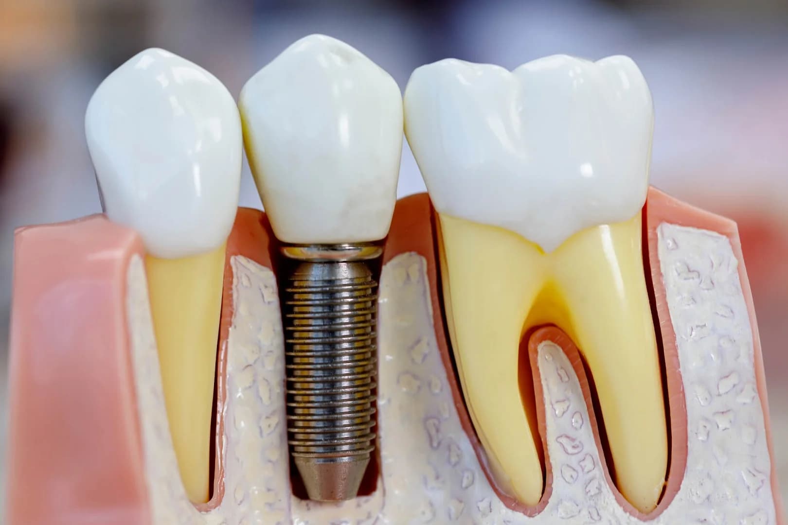 Dent-São Clínica Odontológica | Alinhadores | Aparelhos Invisíveis | Invisalign | Sousmile | Prótese | Implantes – foto 3
