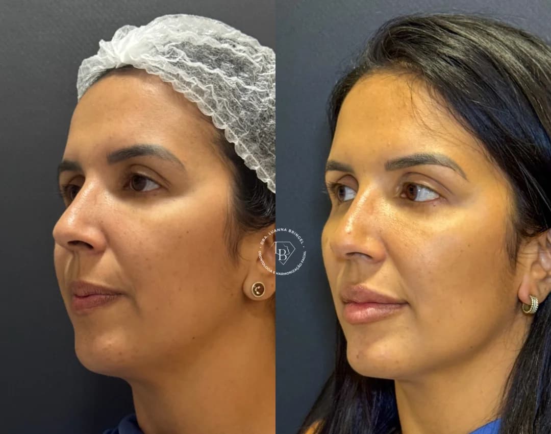 Harmonização Facial em Teresina | Dra. Luanna Bringel | Toxina Butolínica | Preenchimento Labial | Lente de Contato Dental – foto 2