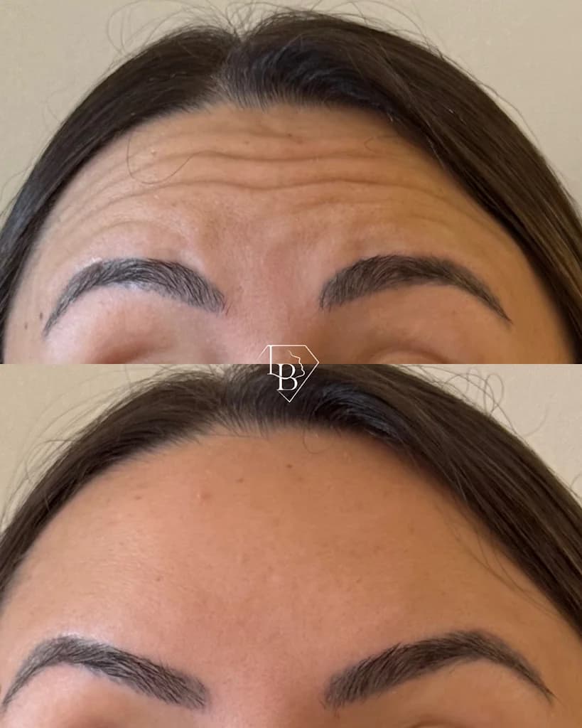 Harmonização Facial em Teresina | Dra. Luanna Bringel | Toxina Butolínica | Preenchimento Labial | Lente de Contato Dental