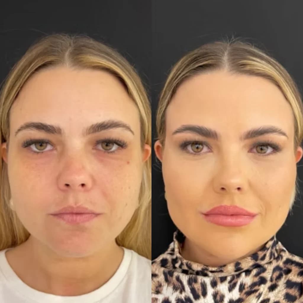 Clínica Pró Estética Perdizes, Ultraformer MPT, Fotona, Gordura Localizada, Botox Facial, Lipo Sem Cortes, Hipro, Liftera – foto 2