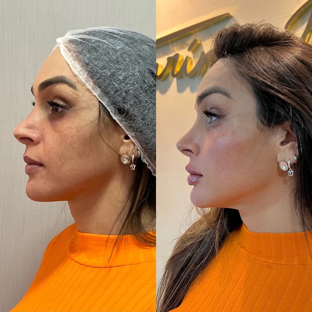 DRA KATARINA BESSA - HARMONIZAÇÃO FACIAL EM NATAL – foto 3