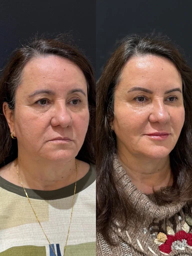 Harmonização Facial Avançada em Juiz de Fora | Dra. Isabele Bragança