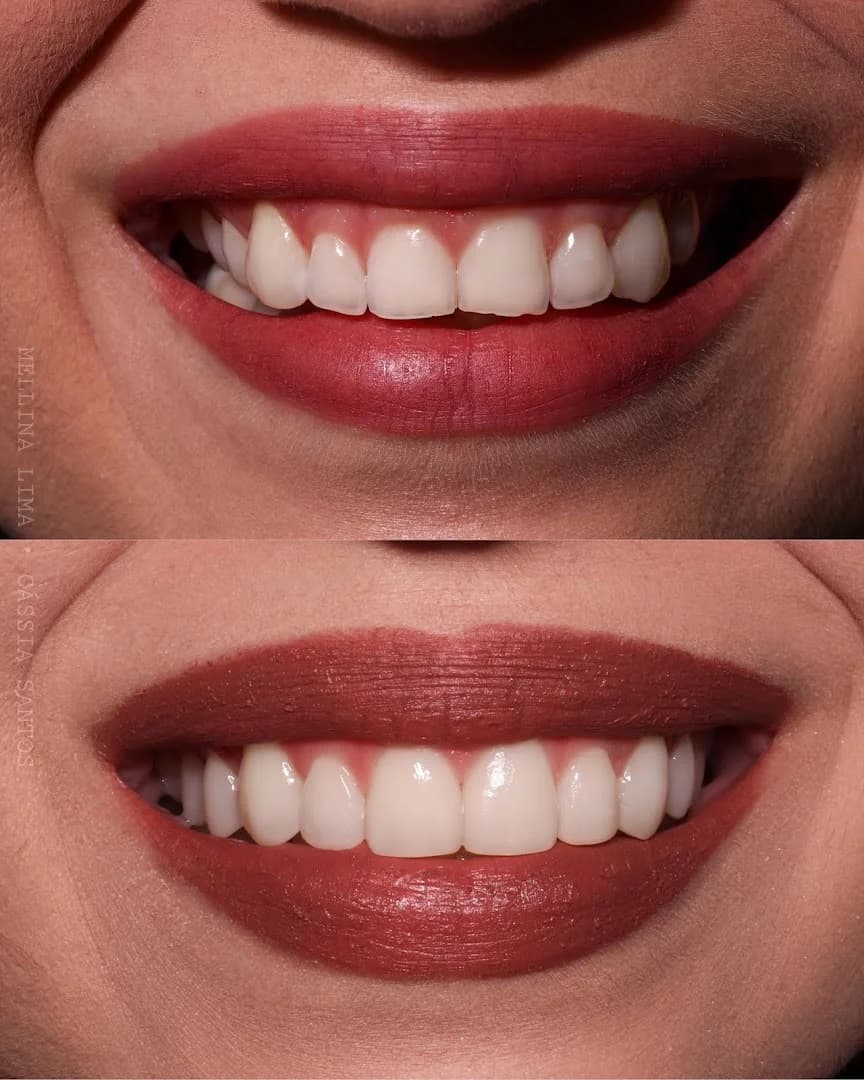 Dra. Mellina Lima - | Aparelho Invisível | Clareamento | Gengivoplastia – foto 3
