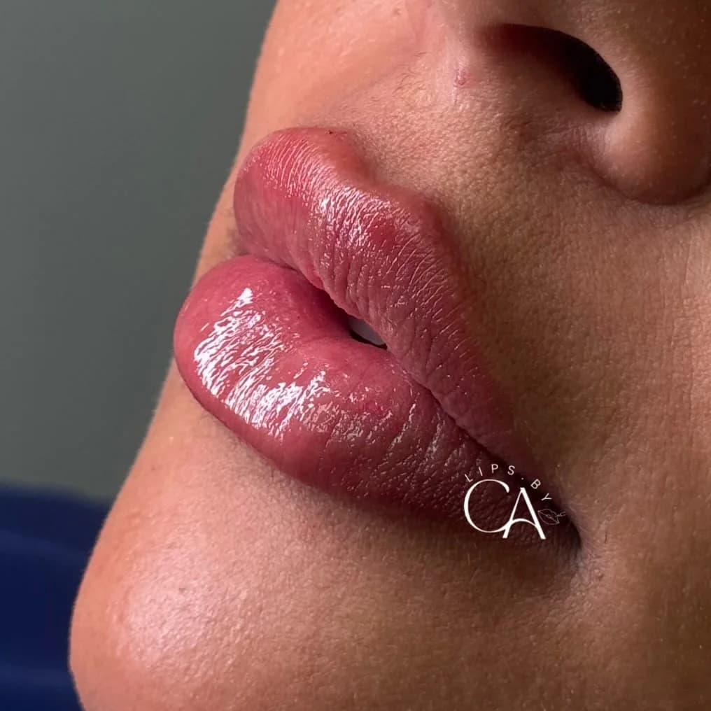 Dra. Carolina Andrade - Preenchimento Labial em Recife | Harmonização Facial em Recife – foto 1