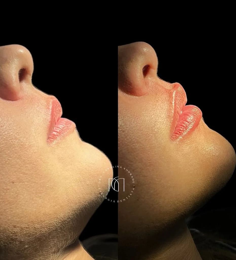 Dra. Carolina Andrade - Preenchimento Labial em Recife | Harmonização Facial em Recife