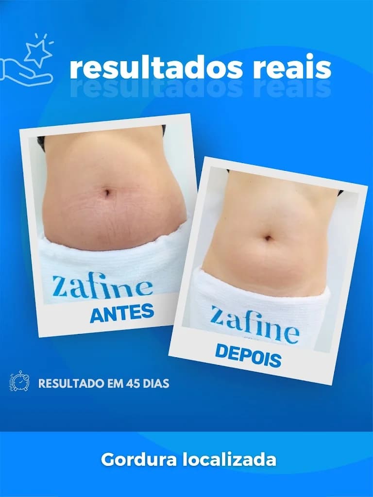 Zafine depilação a laser em Viamão – foto 2