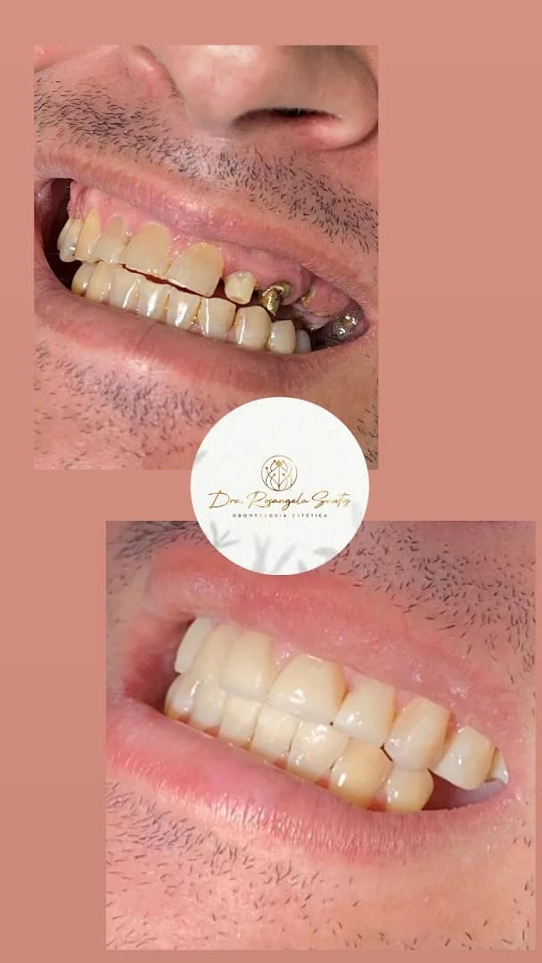 Dra. Rosangela Santos | Dentista em Maceió | Facetas em Resina em Maceió – foto 3