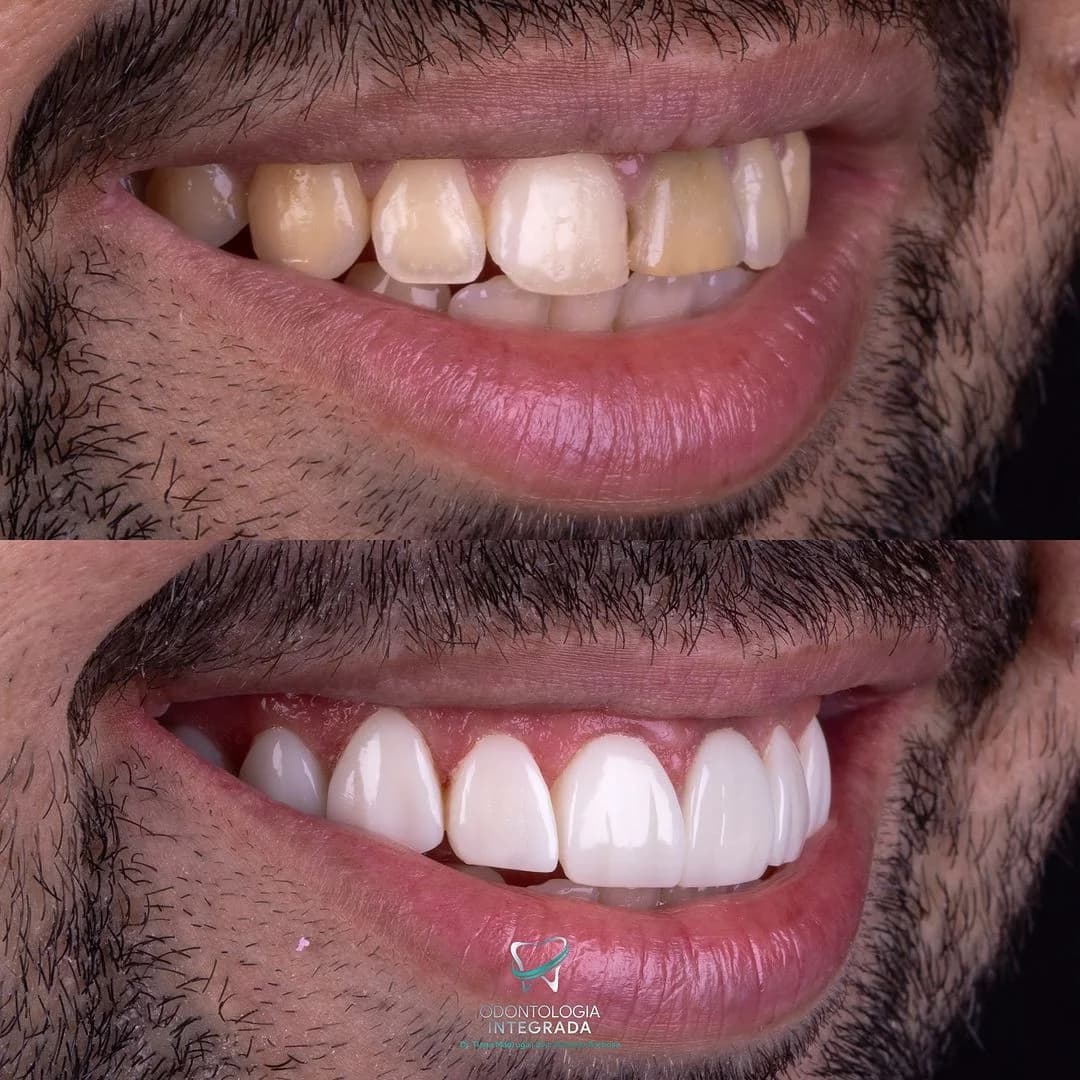 Odontologia Integrada Natal | Implante sem corte, sem dor e resultado imediato | Dentista em Natal/RN – foto 2