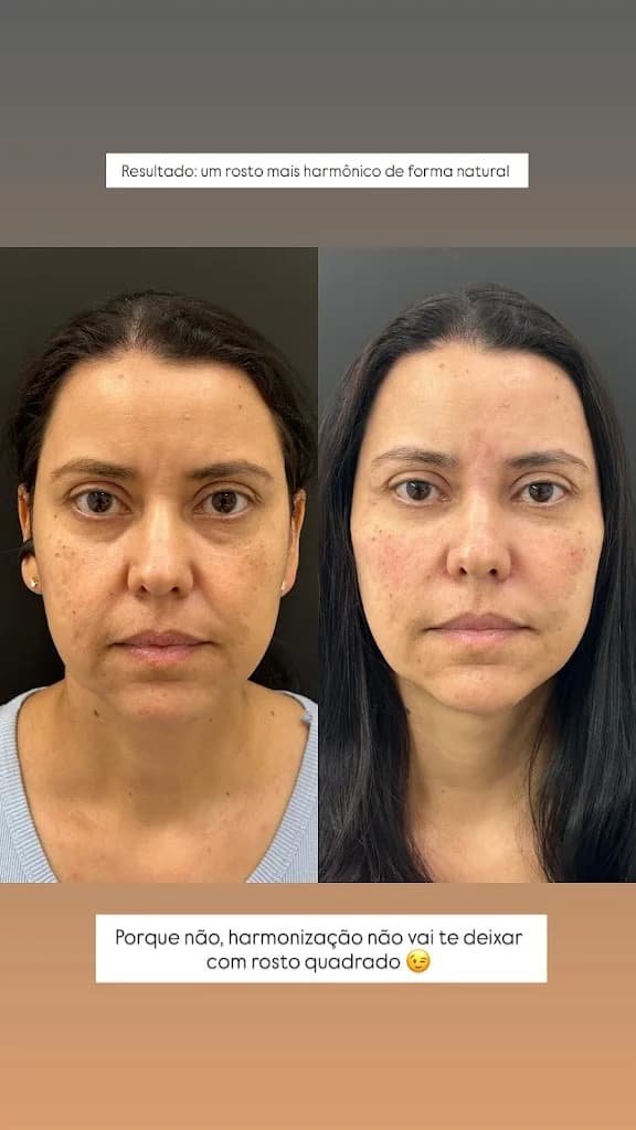 Dra. Luana Valentino - Harmonização Facial – foto 3