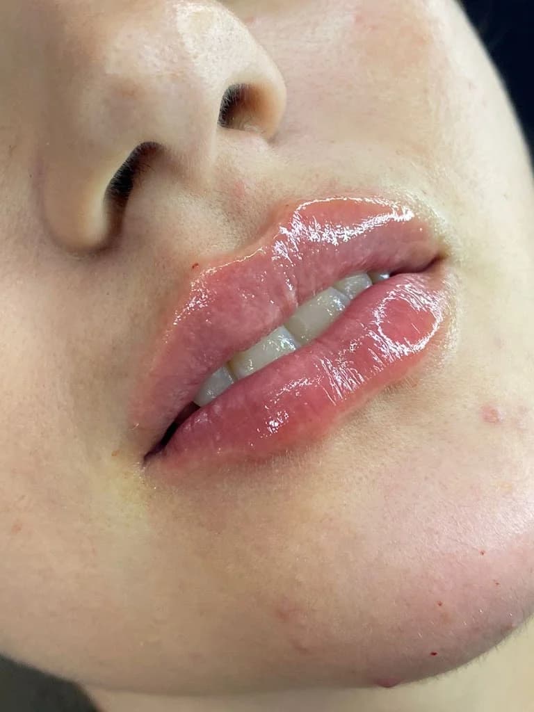 Harmonização Facial em João Pessoa - Dra. Carolina Bandeira l Fios de PDO l Preenchimento Facial e Labial João Pessoa – foto 3
