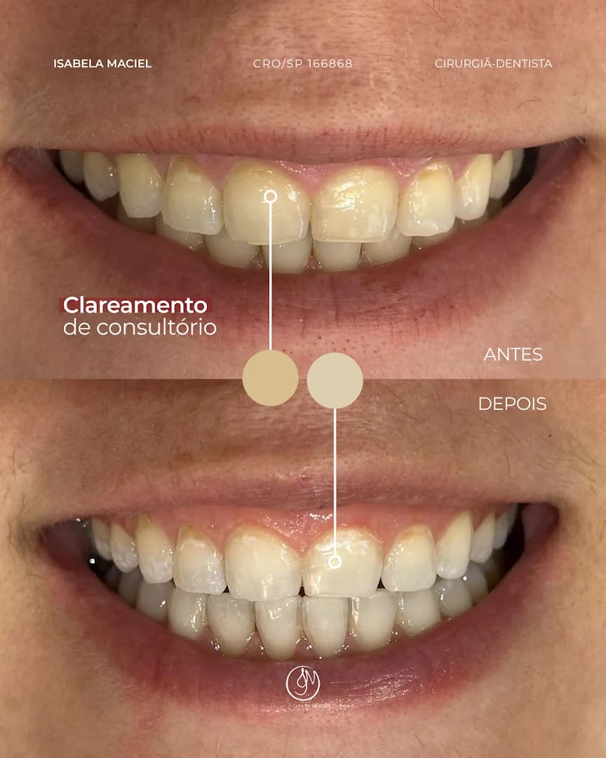 Dra. Isabela Maciel | Clareamento dental, Restaurações, Tratamento de canal