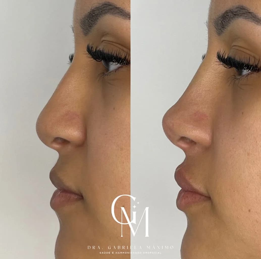Harmonização Facial - Dra. Gabriela Máximo – foto 3