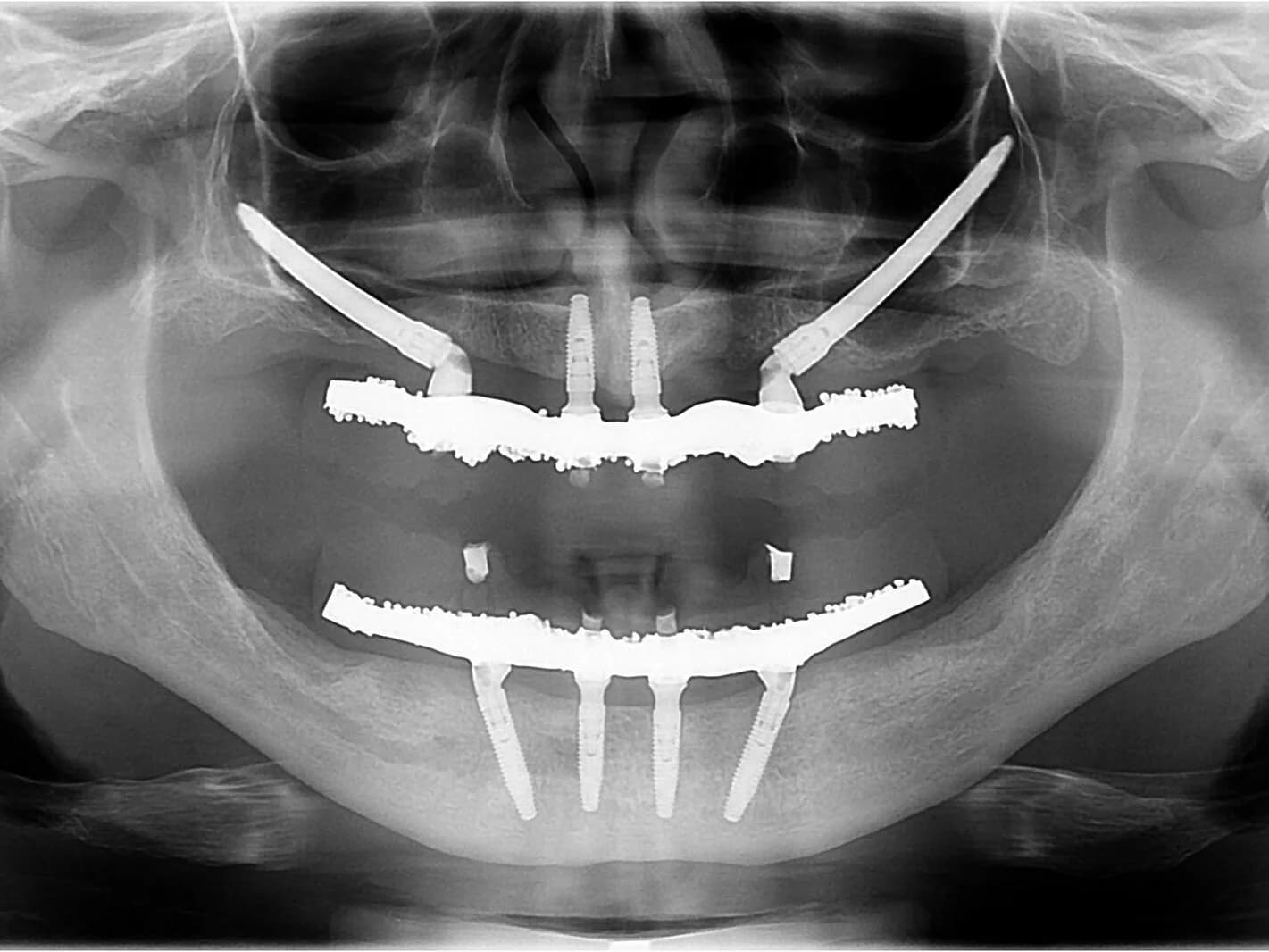 L R Odontologia - Dra. Lucimar Rocha - Implantes Dentários