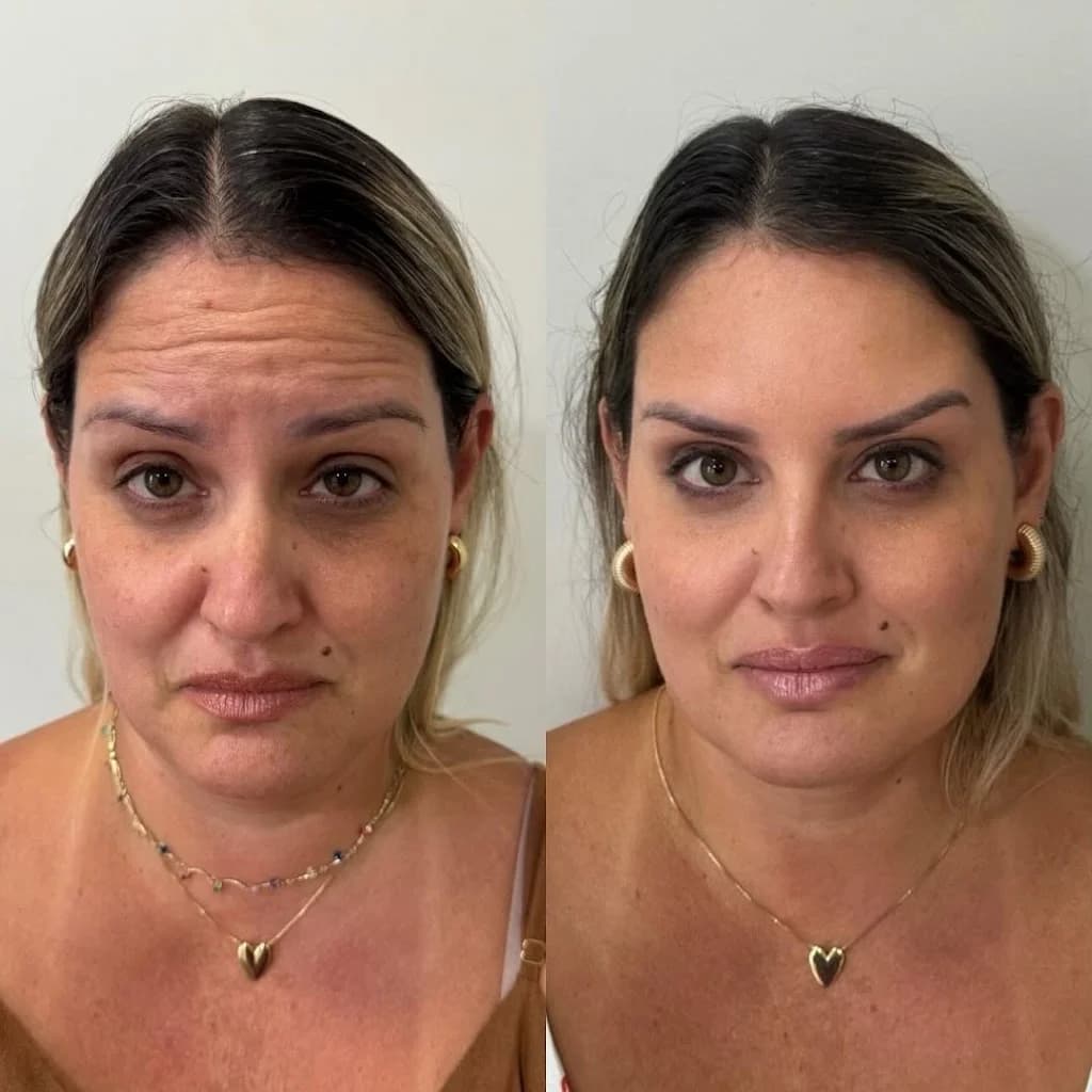 Dra Samira Galvani - Harmonização Facial em Piracicaba – foto 3