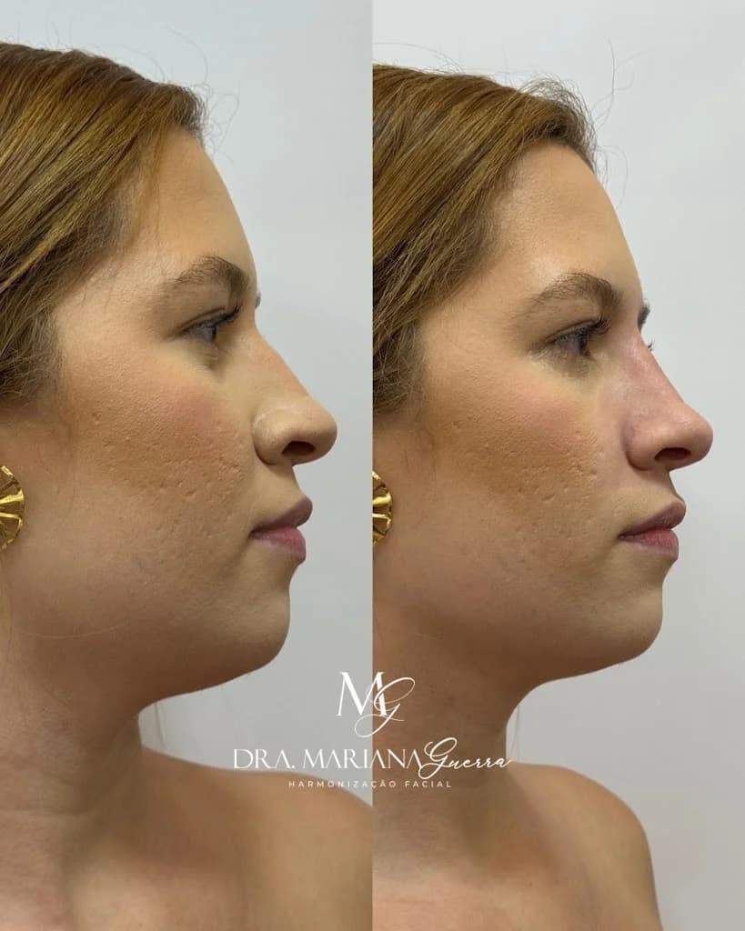 Dra. Mariana Guerra Harmonização Facial em Fortaleza – foto 3