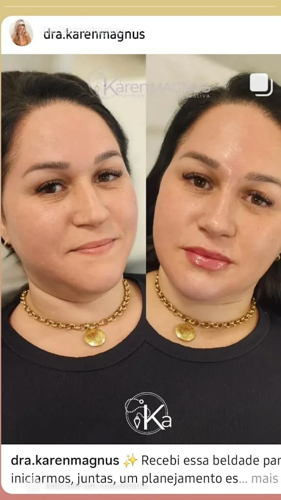 KAREN MAGNUSS l Harmonização Facial e Corporal | Gravataí RS