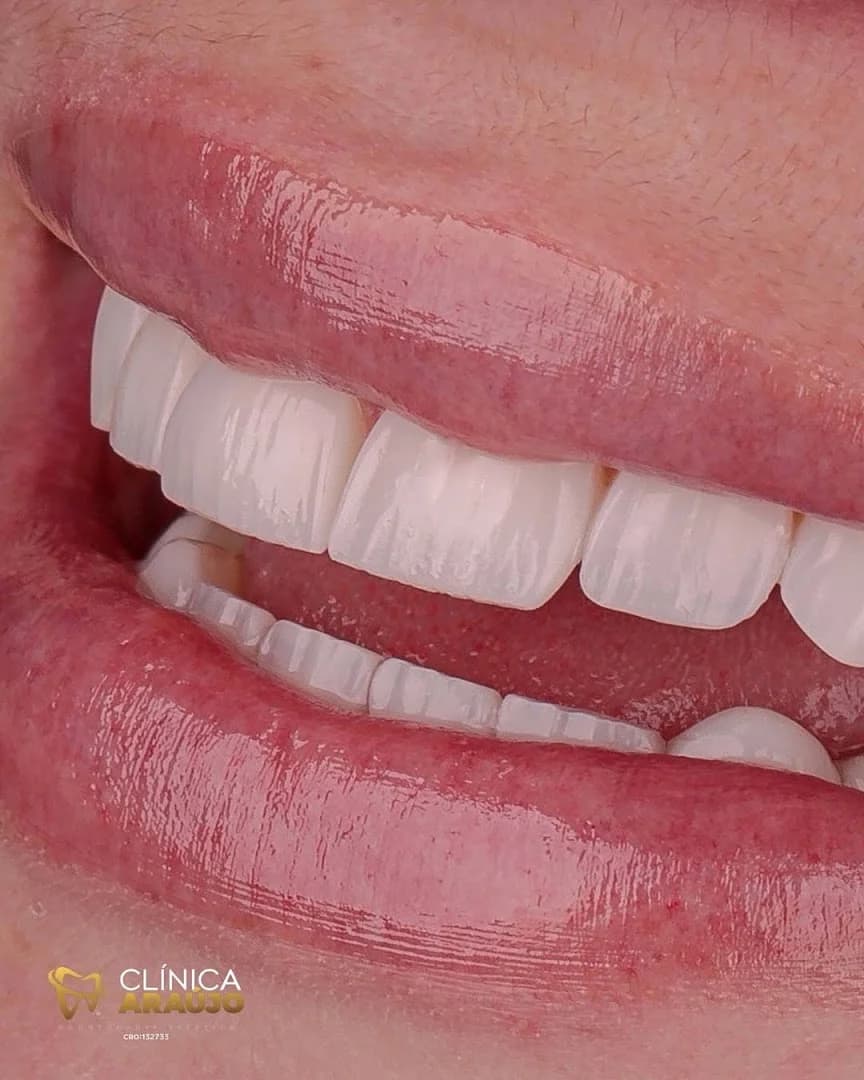 Clinica Felipe Araújo BH - Facetas de Resina em Belo Horizonte - Lentes de Contato Dental - Lentes de Porcelana – foto 1