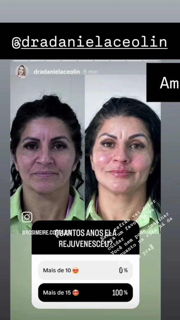 Dra. Daniela Ceolin - Realço sua beleza com Harmonização Facial - Referência FULL FACE com naturalidade