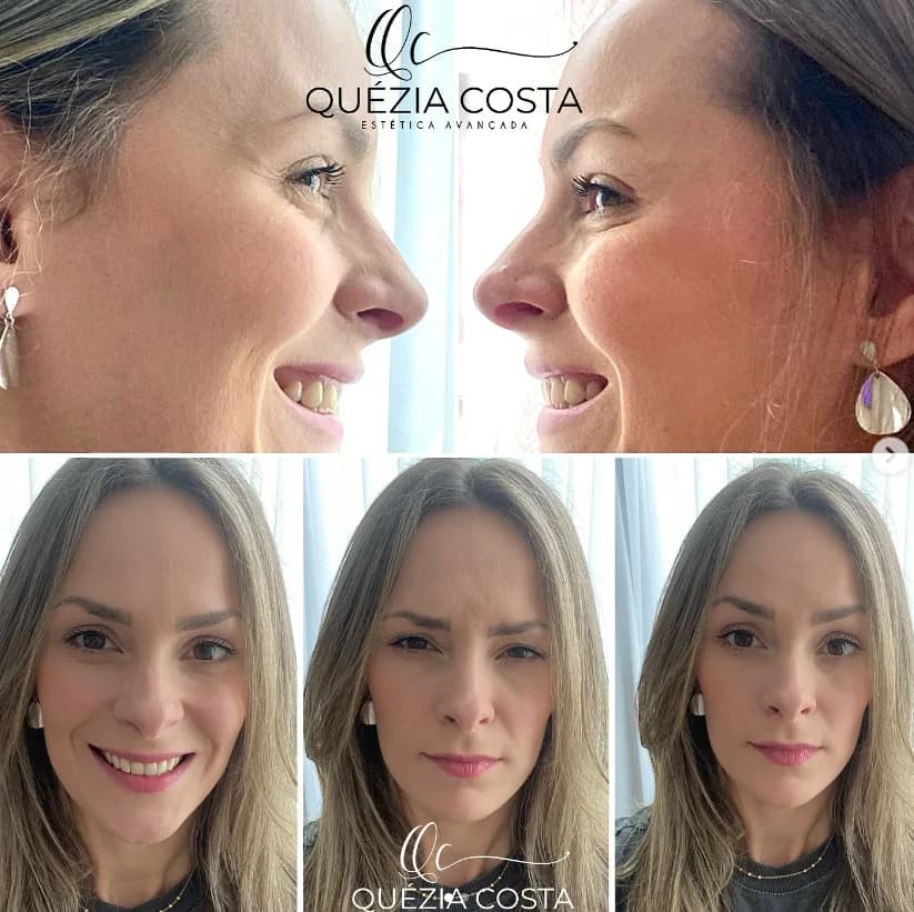 QC Estética Avançada - Quézia Costa - Harmonização Facial em Guarulhos – foto 3