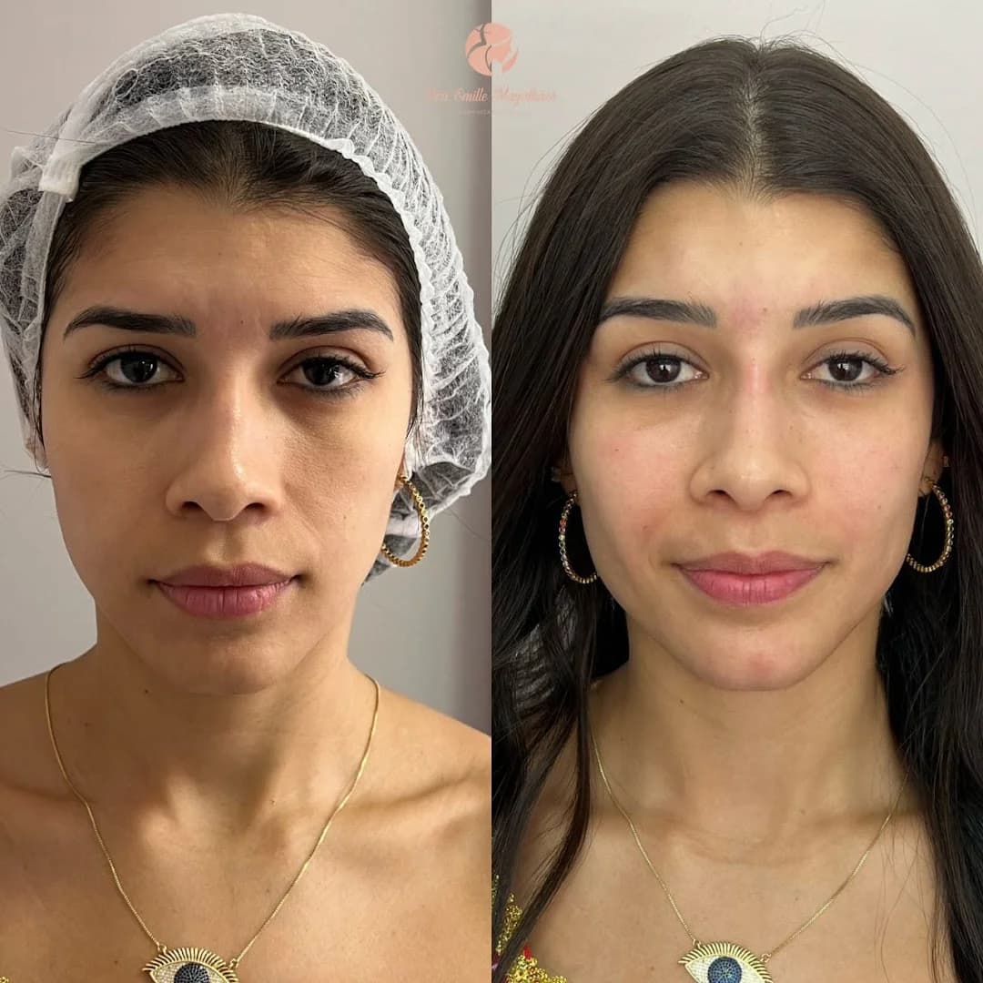 Dra Emille Magalhães - Harmonização Facial