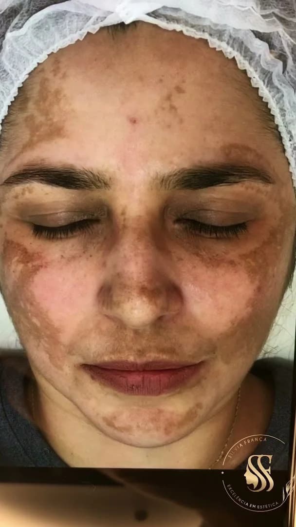 Dra. Silvia França - Especialista em Melasma – foto 2