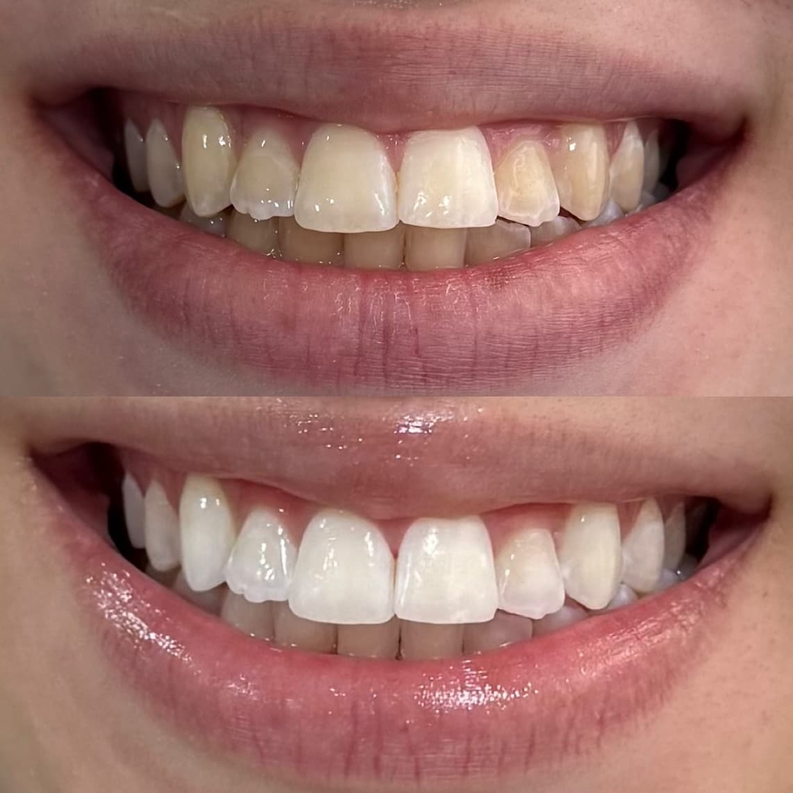 Clareamento Dental Maringa - Dr Guilherme Tomon