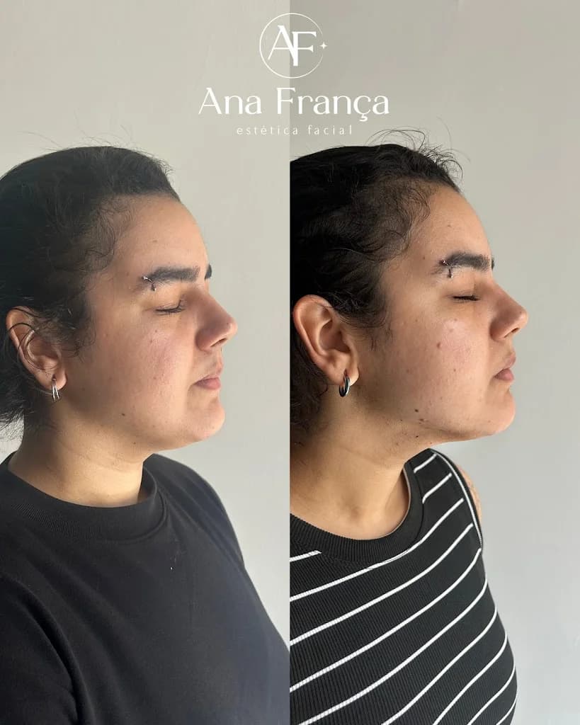 Ana França estetica - especialista em limpeza de pele, manchas e cicatrizes de acne NATAL/RN – foto 3