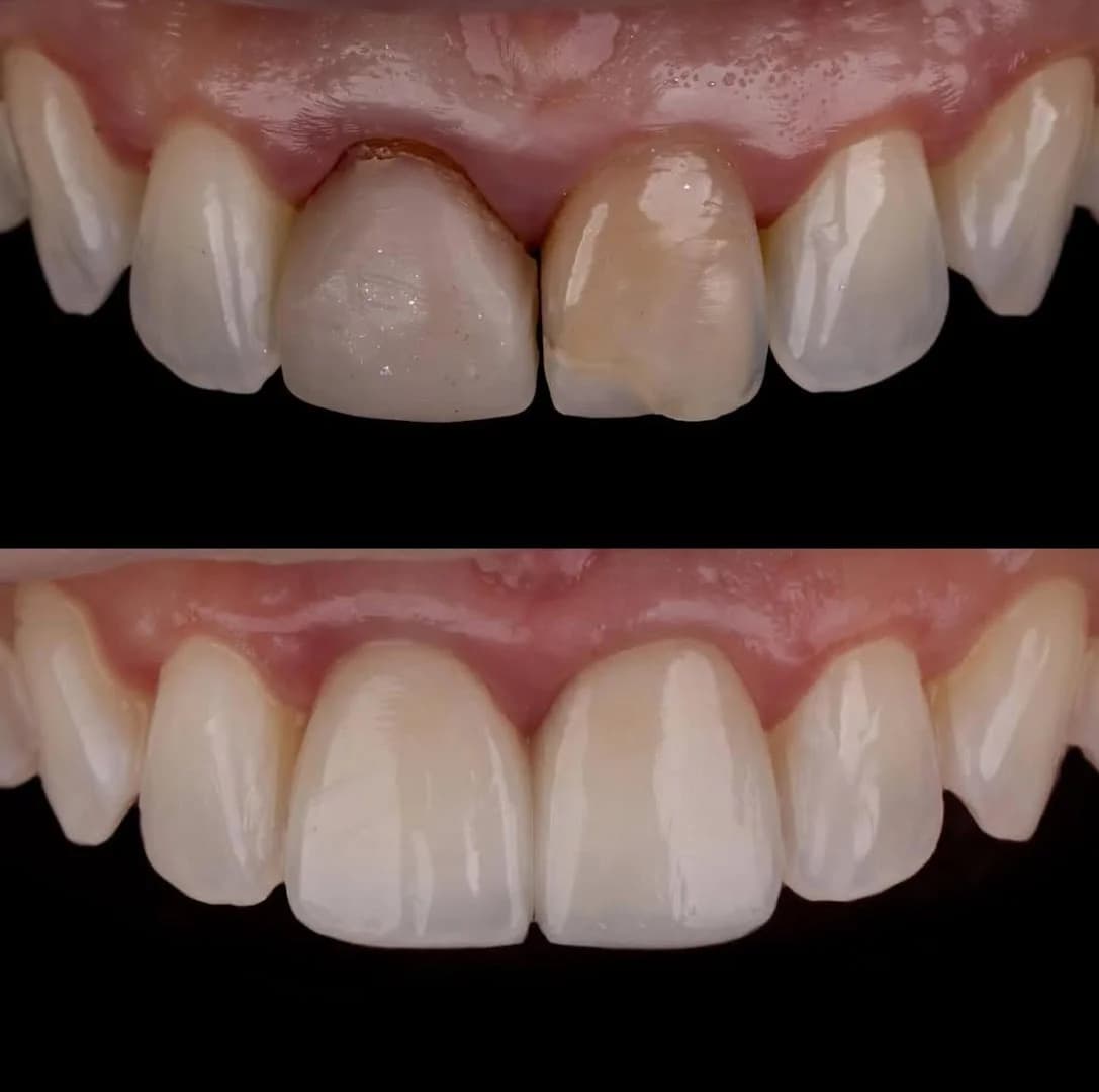 Ortoestética Boa Viagem Sul | Facetas | Implantes | Ortodontia | Invisalign | Harmonização – foto 2