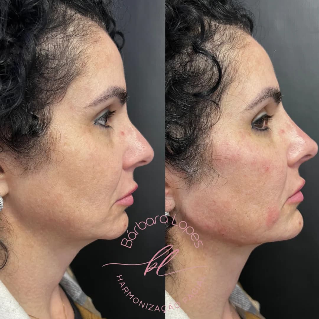 Dra Bárbara Lopes harmonização facial – foto 1