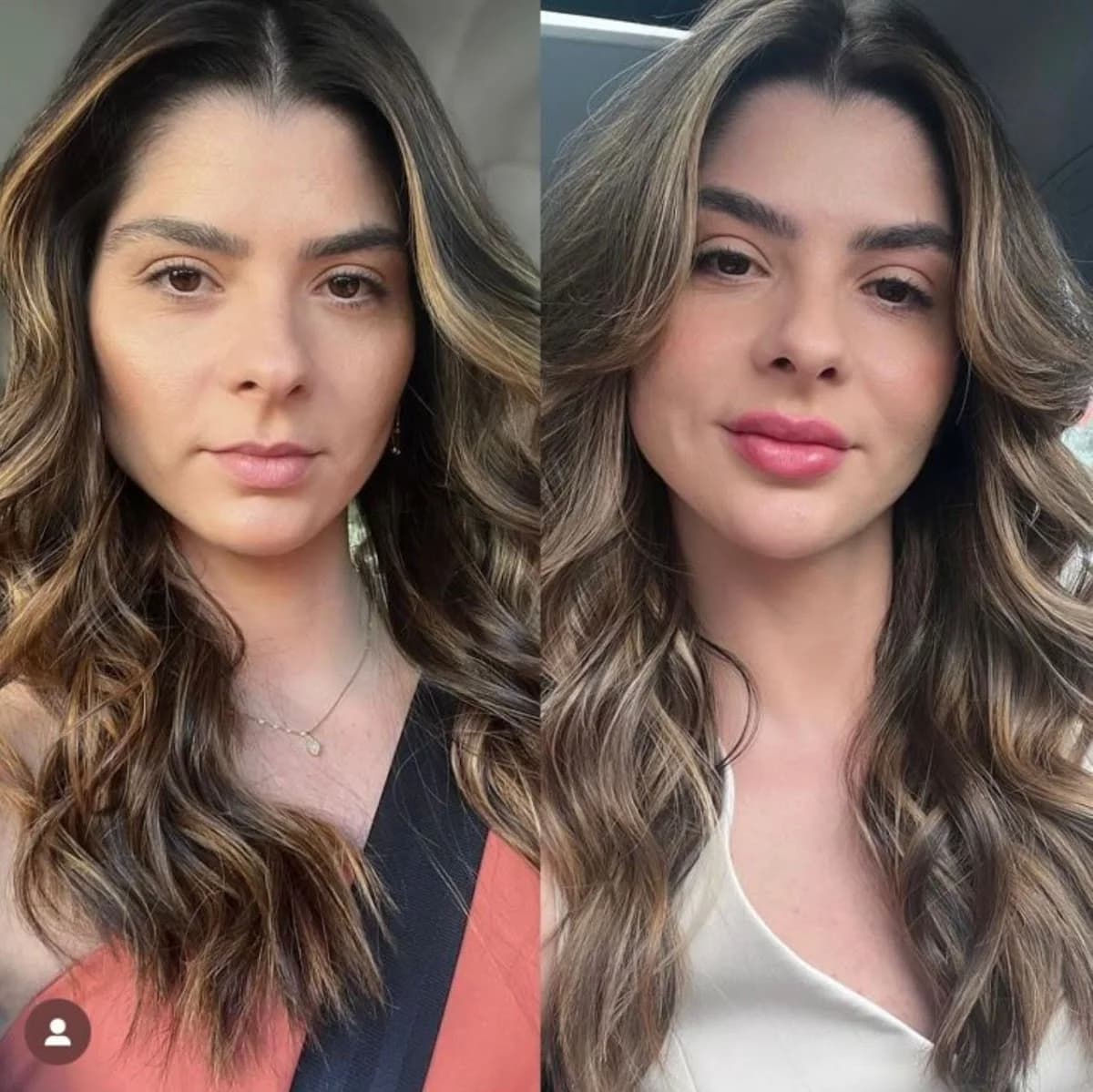 Dra Bárbara Lopes harmonização facial – foto 2