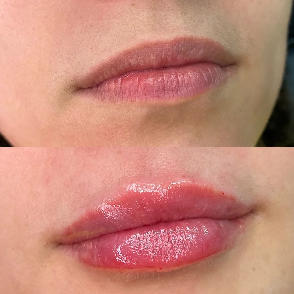 Dra Bárbara Lopes harmonização facial – foto 3