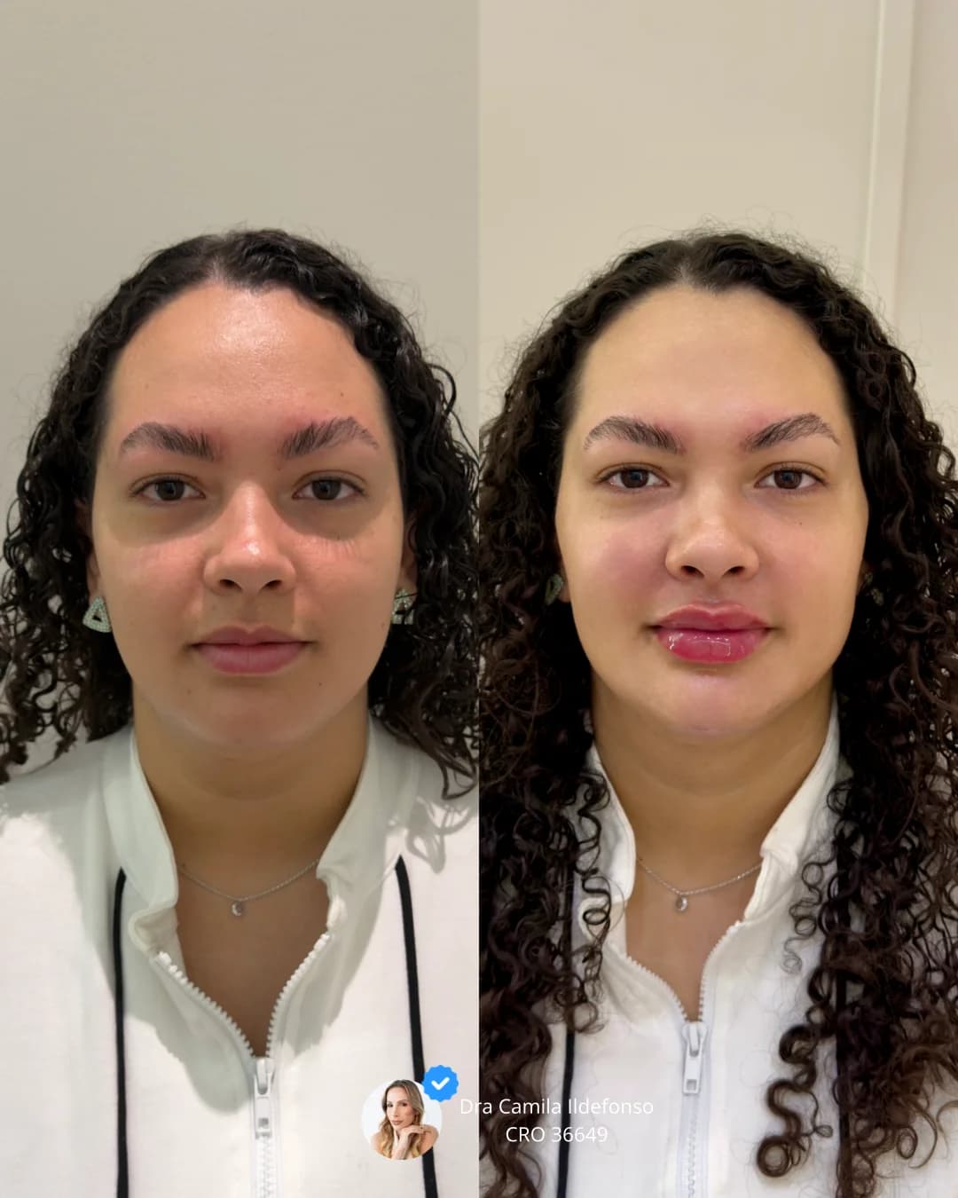 Dra Camila Ildefonso | Harmonização Orofacial – foto 2