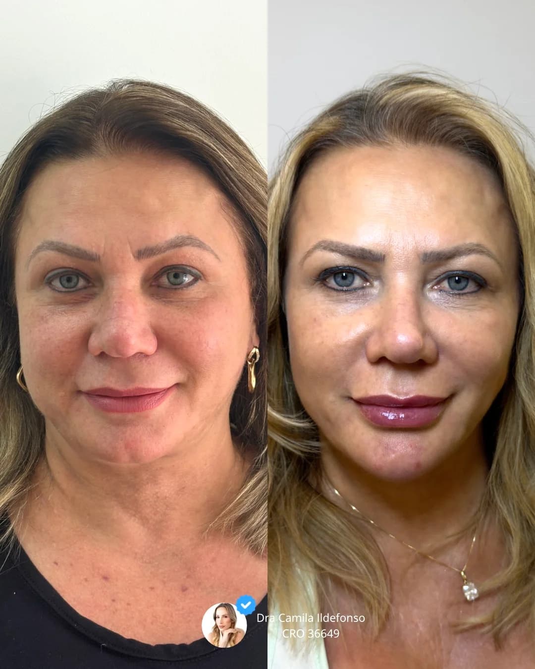 Dra Camila Ildefonso | Harmonização Orofacial – foto 3