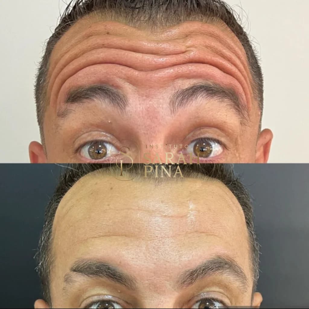 Dra. Sarah Pina - Harmonização Facial Uberlandia - Preenchimento Labial - Botox - Rinomodelação ⭐ – foto 2