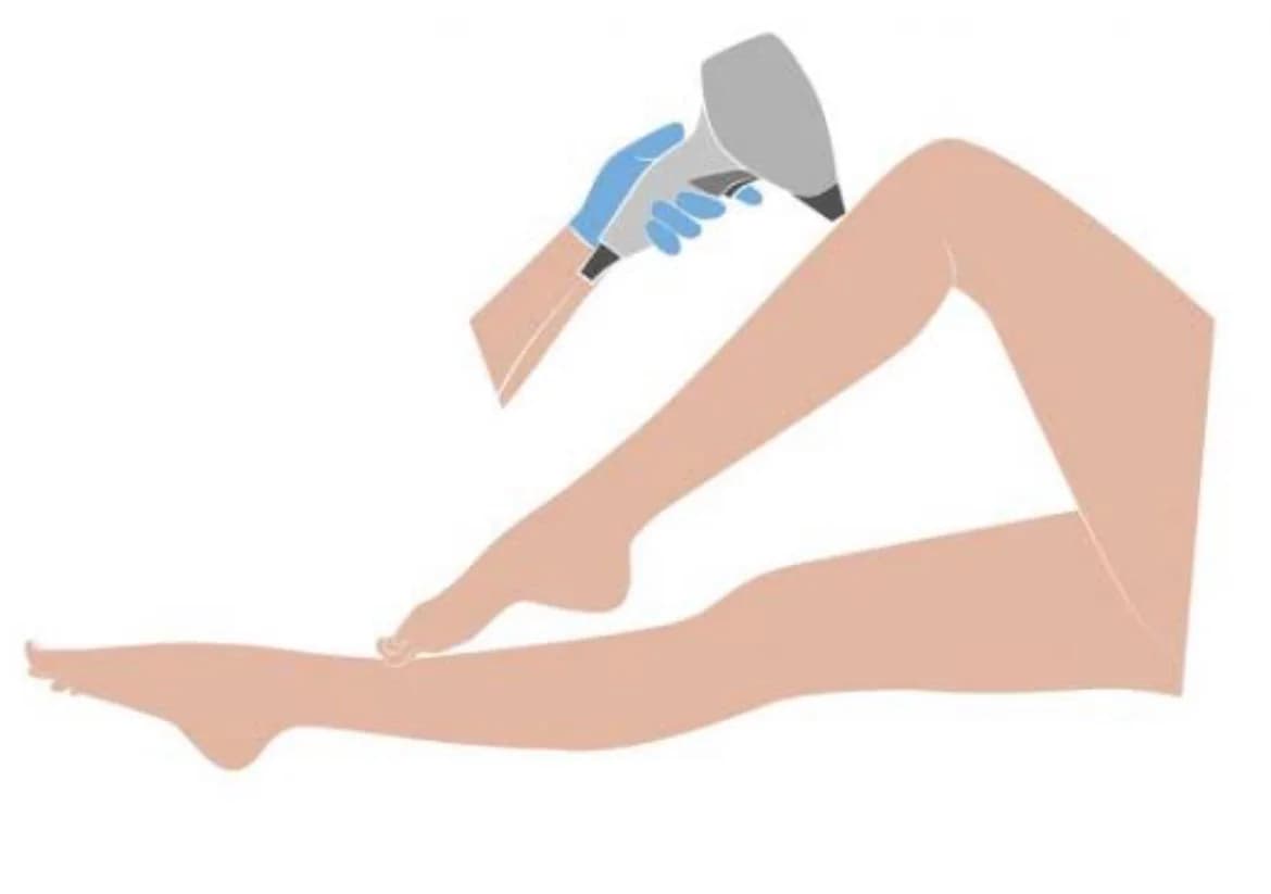 Depilação a Laser Fisio Natural-Ribeirão Preto – foto 3