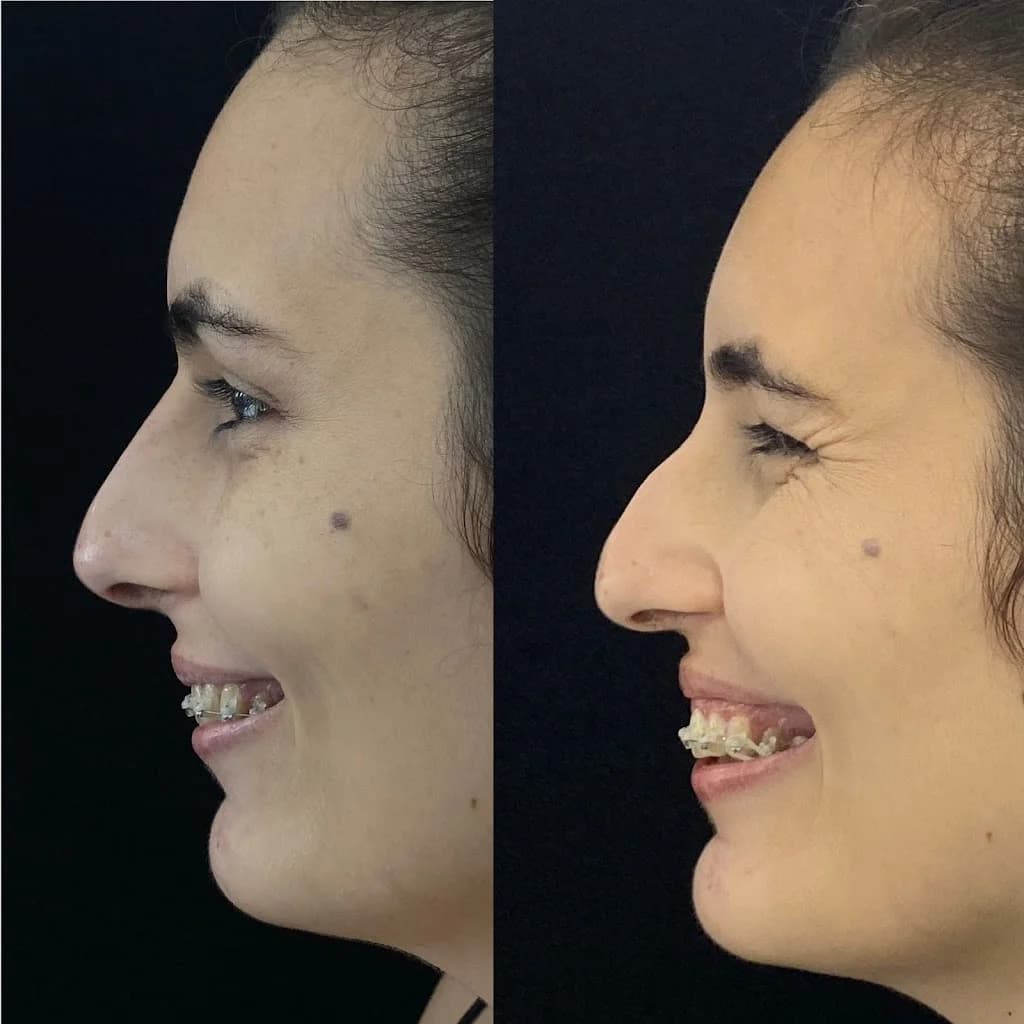 Harmonização Facial em João Pessoa - Dra. Carolina Bandeira l Fios de PDO l Preenchimento Facial e Labial João Pessoa – foto 2