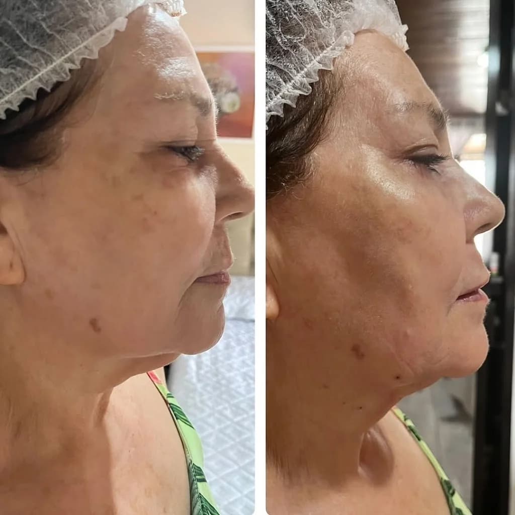 Dra. Luana Brandão | Harmonização Facial – foto 3