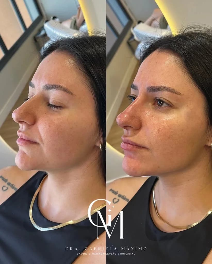 Harmonização Facial - Dra. Gabriela Máximo