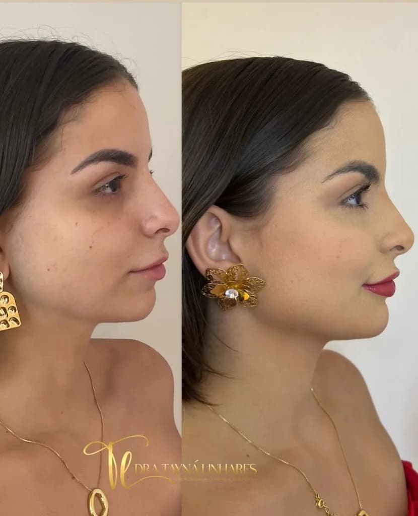 Dra. Tayná Linhares - Especialista em Harmonização Glútea e Orofacial – foto 3