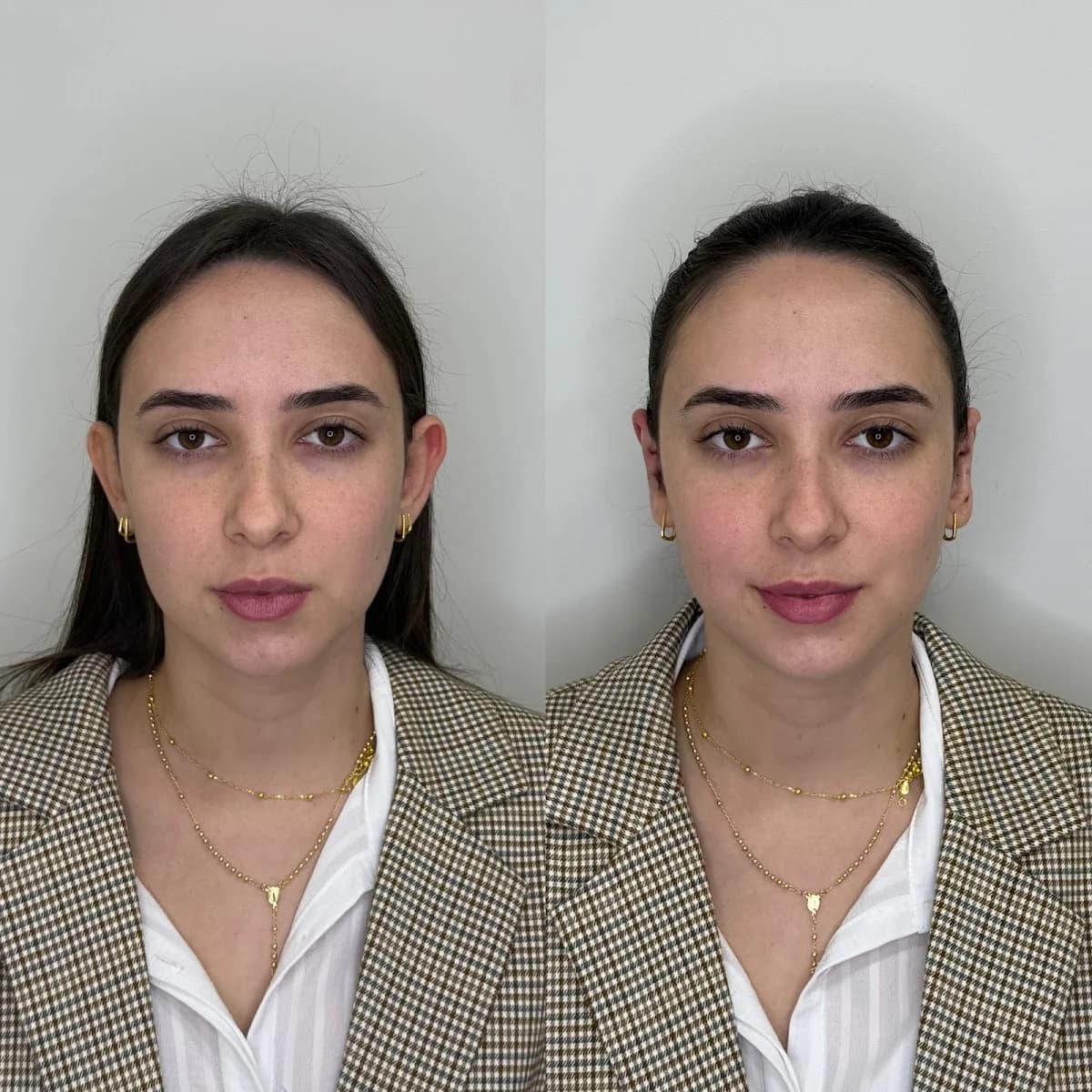 Dra. Rafaela Inojosa | Harmonização Facial | Otomodelação | Botox | Maringá – foto 2