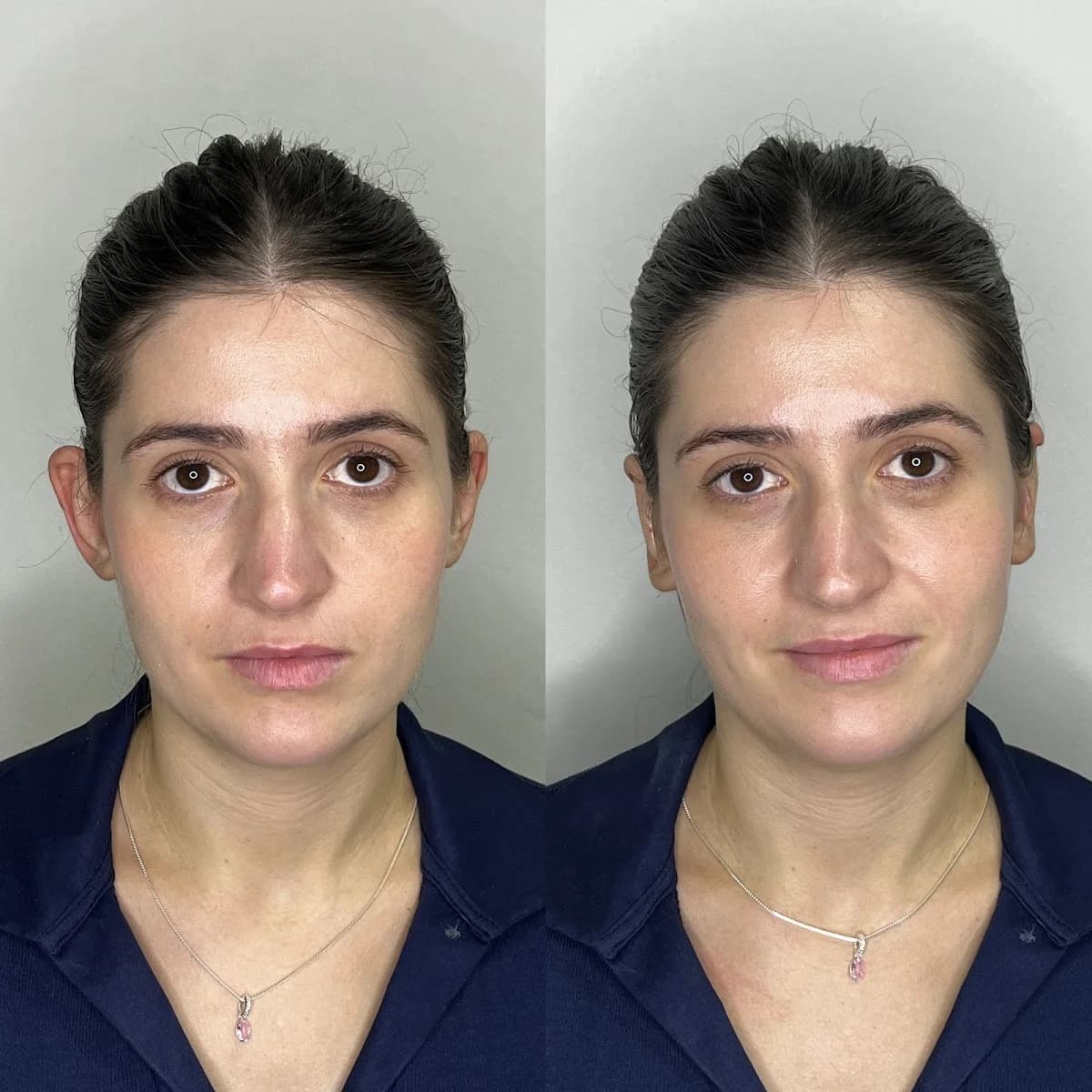 Dra. Rafaela Inojosa | Harmonização Facial | Otomodelação | Botox | Maringá – foto 3