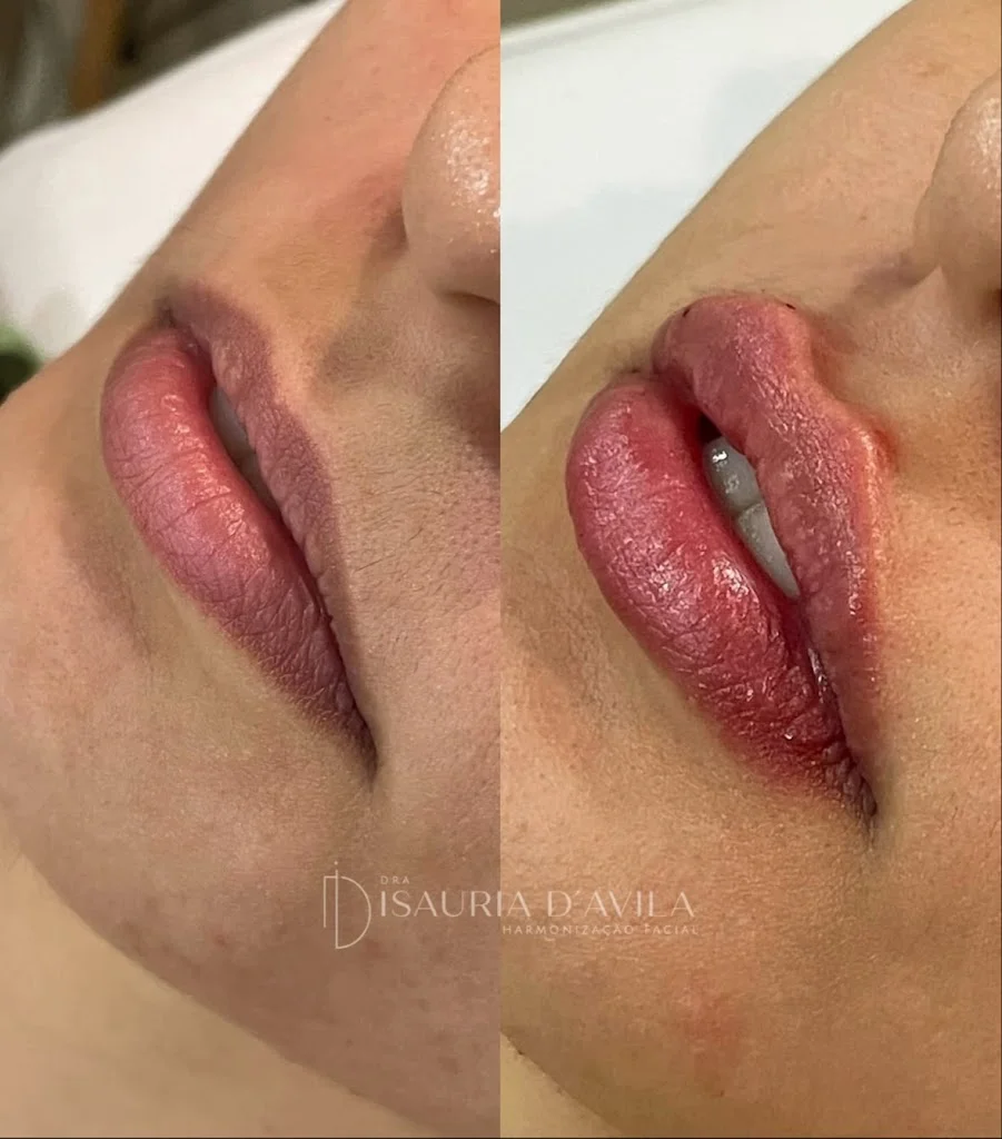 Dra Isauria d'Avila - Harmonização Facial