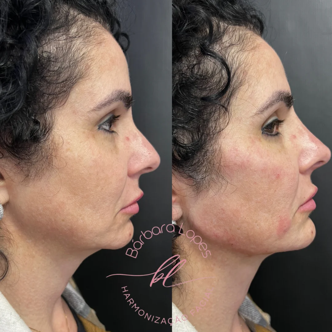 Dra Bárbara Lopes harmonização facial