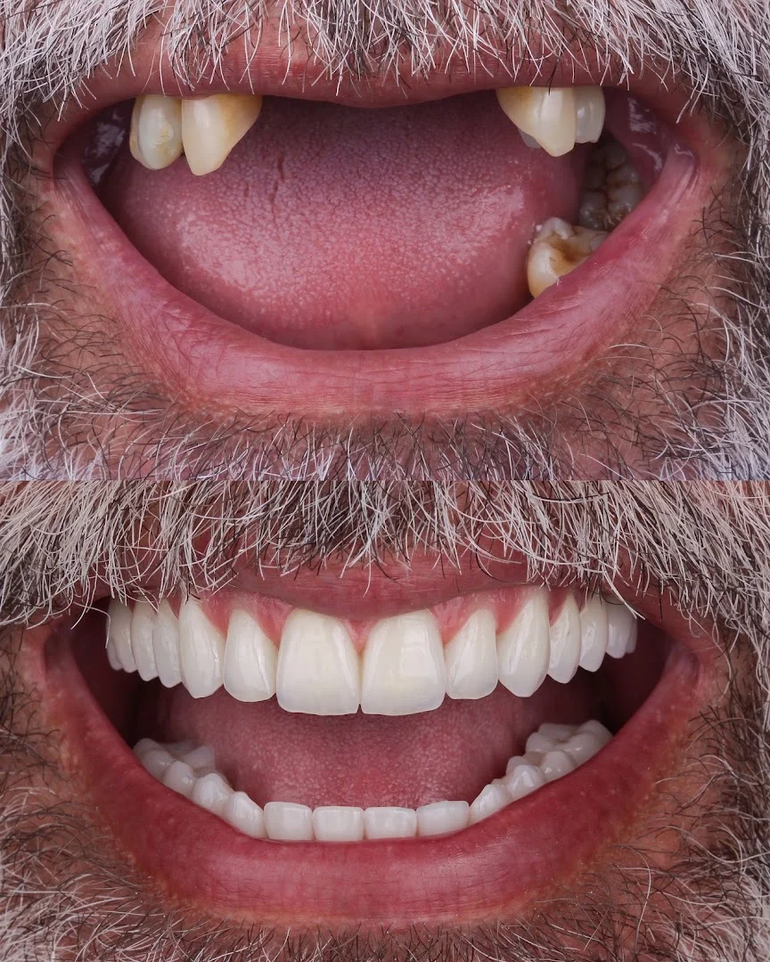 Oralfy Belém | Implante | Invisalign | Dentista em Belém