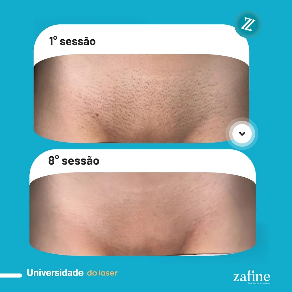 Zafine depilação a laser em Viamão