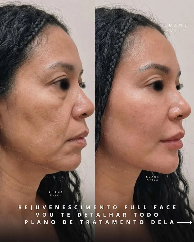 Dra. Luane Ávila -Preenchimento labial, rinomodelação, Perfiloplastia, full face, olheiras, lip lift em Salvador